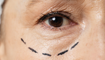 blefaroplastia parpados caidos hm eye center