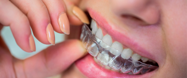 Ortodoncia invisible tratamientos