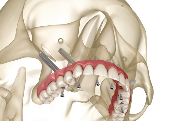 implante dental cigomatico